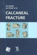 Calcaneal Fracture - cena, porovnanie