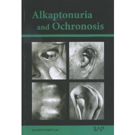 Alkaptonuria and ochronosi