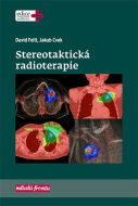 Stereotaktická radioterapie - cena, porovnanie